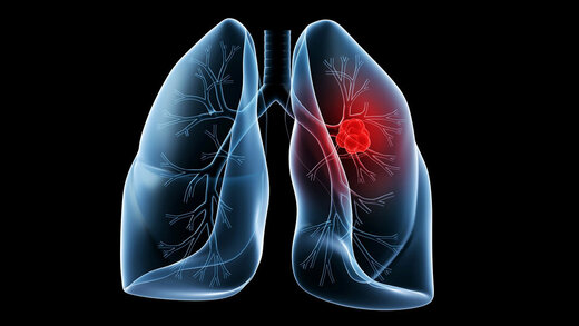 کشف روشی برای درمان یکی از مرگبارترین انواع سرطان ریه