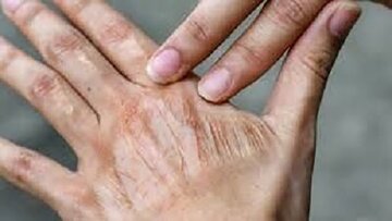 اقدام ساده برای رفع خشکی پوست اقدام ساده برای رفع خشکی پوست